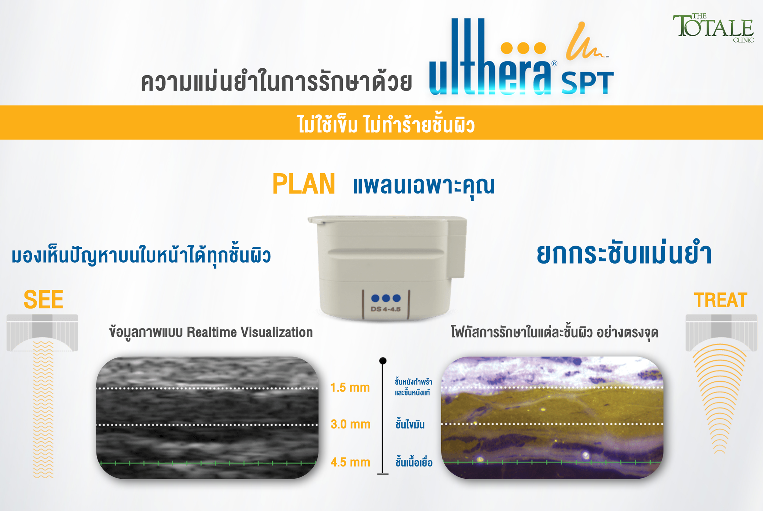 ความแม่นยำในการรักษาด้วย Ulthera