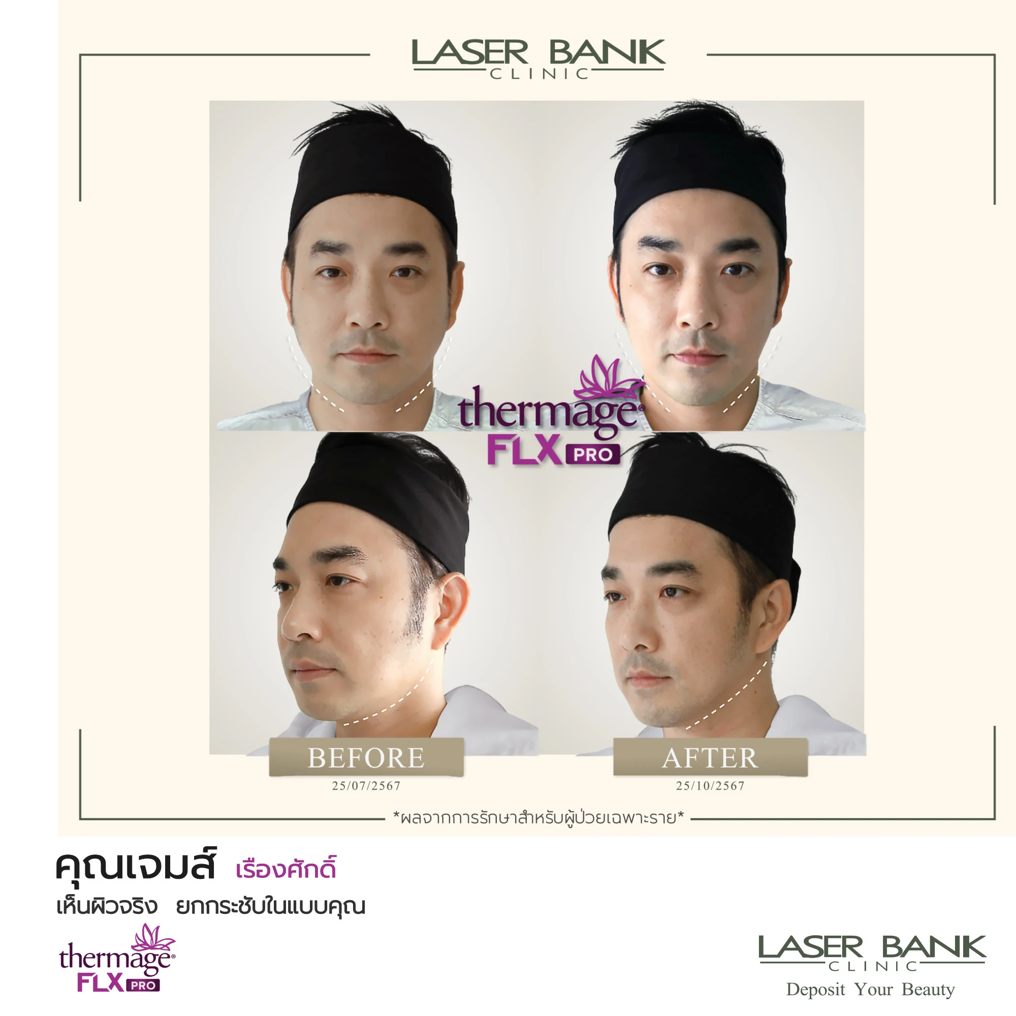 คุณเจมส์ Thermage FLX