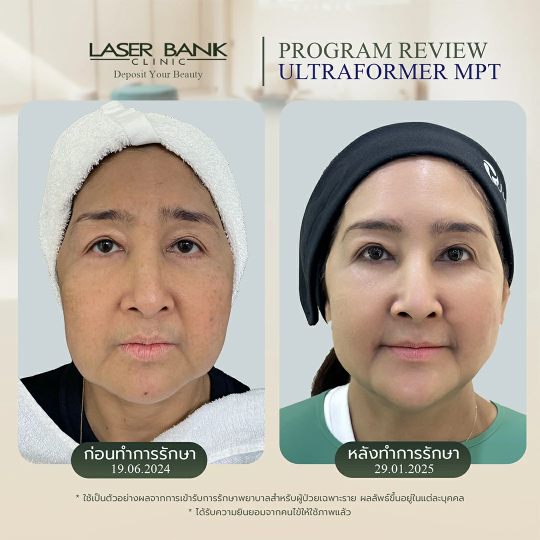 คุณเบญญา Ulthera SPT
