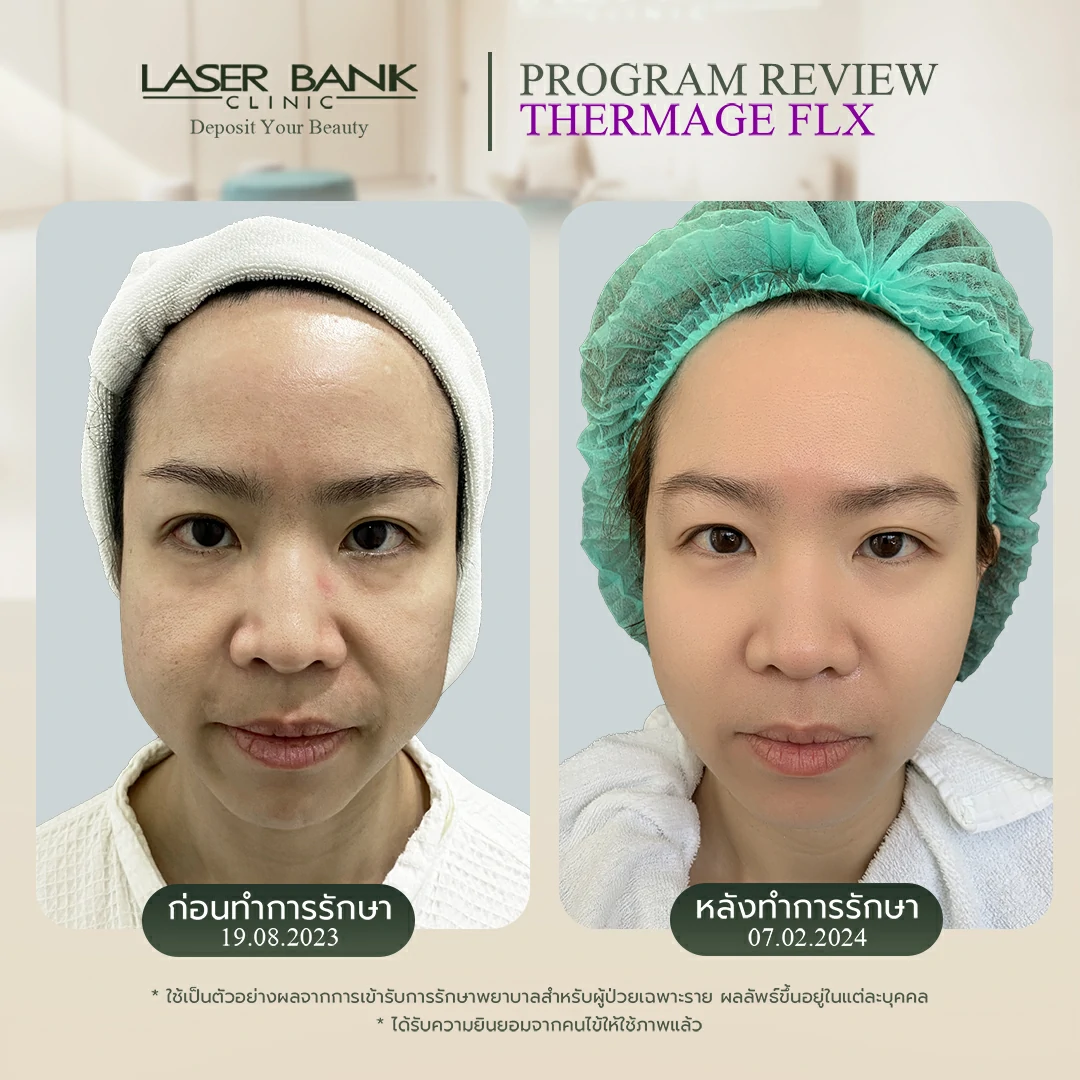 คุณเบญญา Ulthera SPT