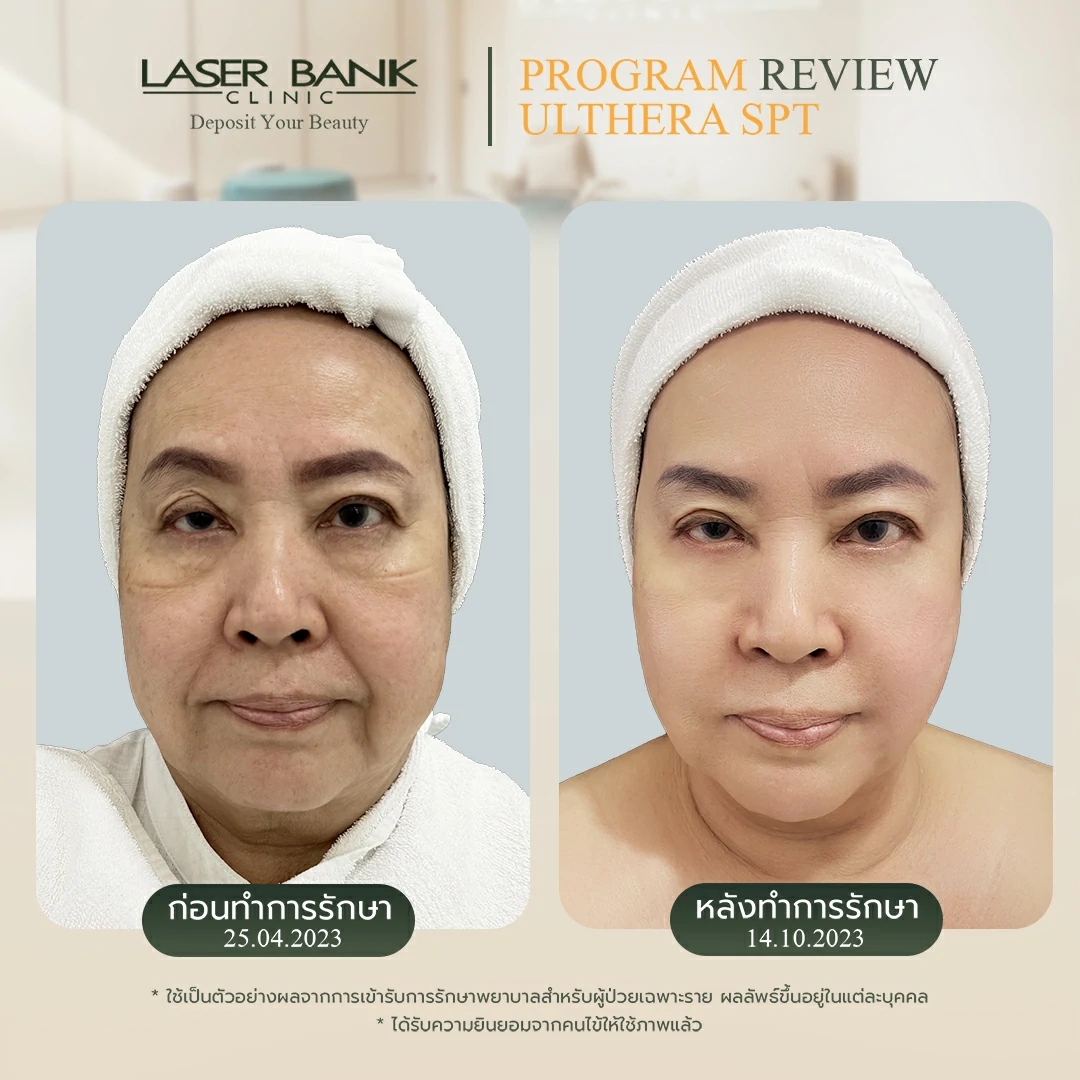 คุณเบญญา Ulthera SPT