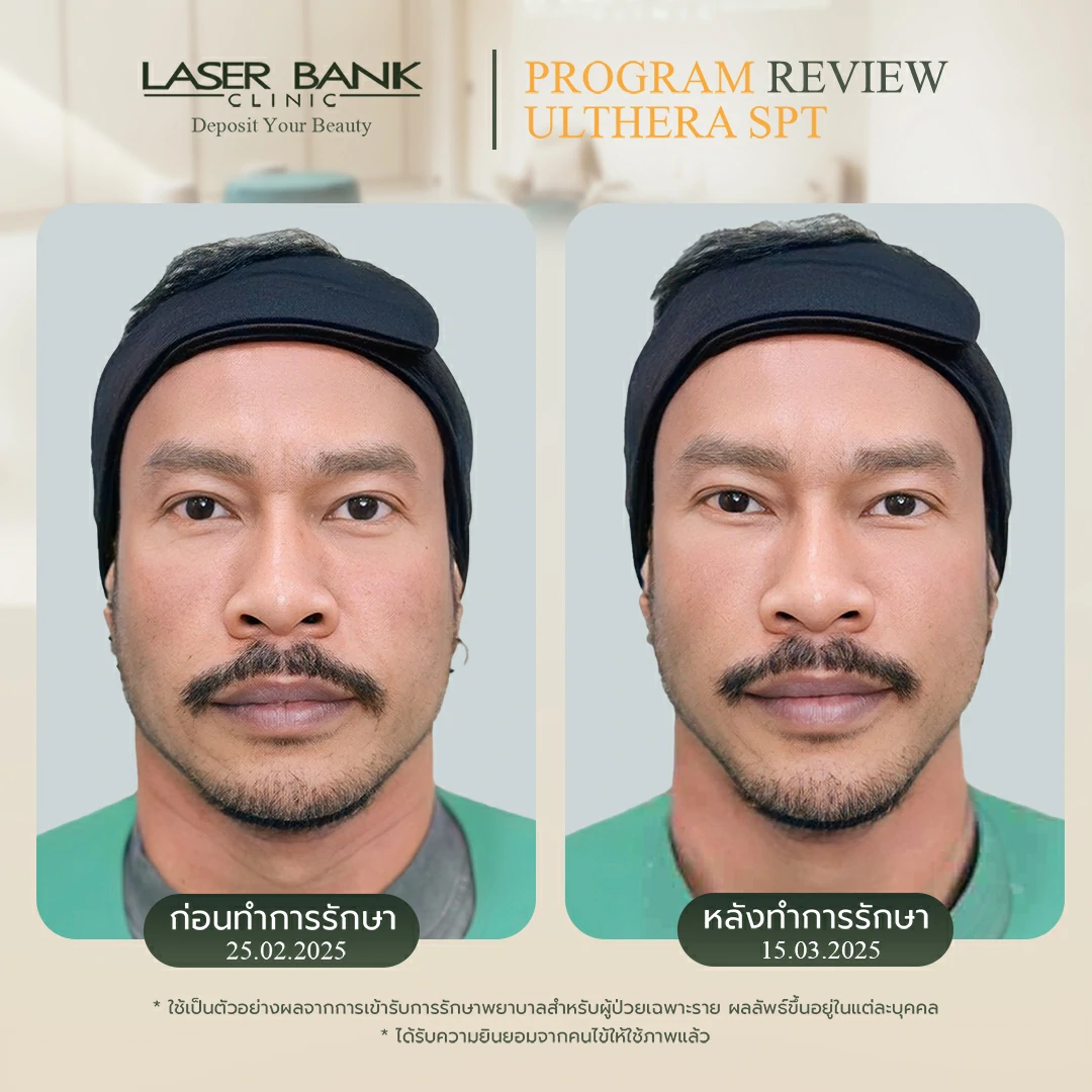 คุณเบญญา Ulthera SPT