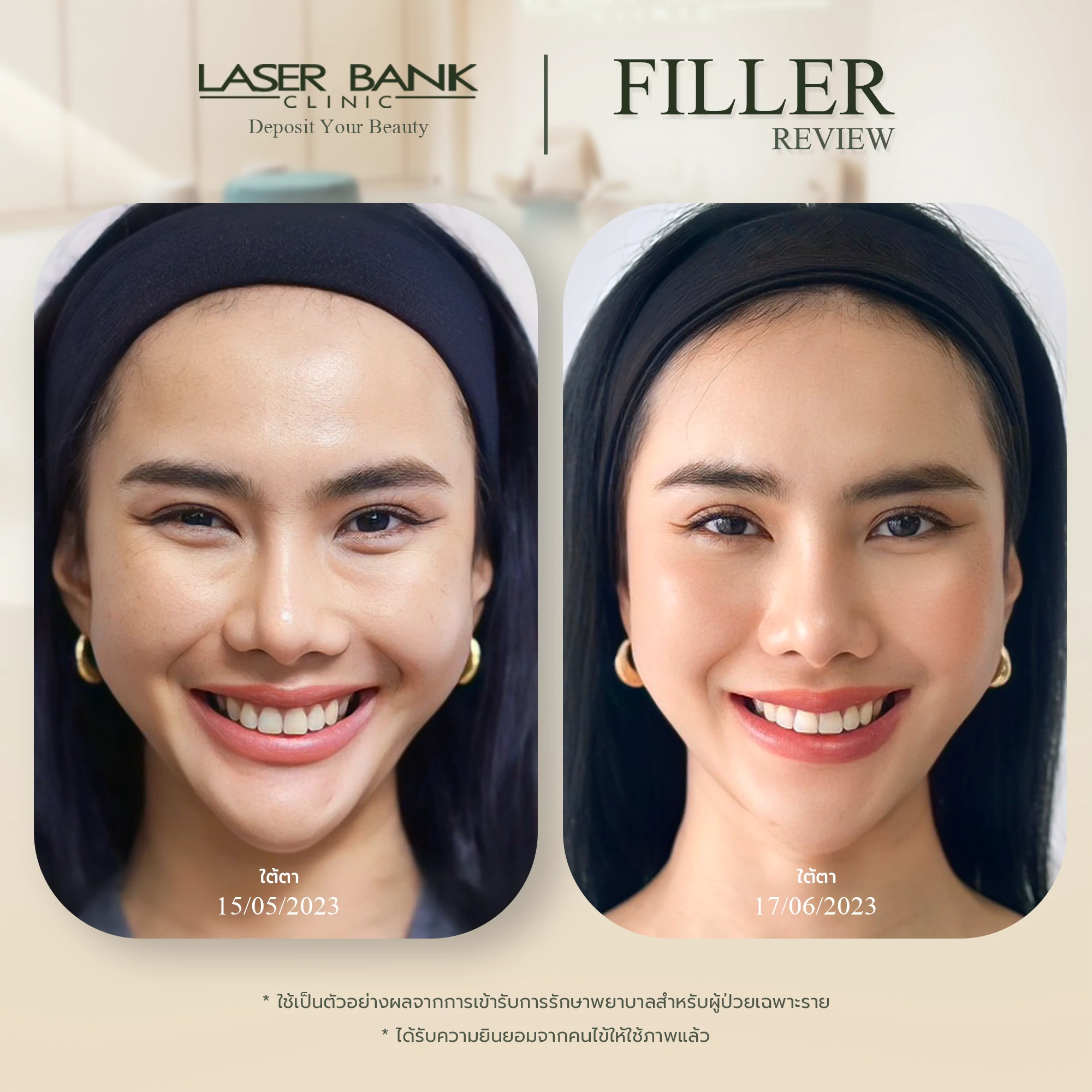 filler before after