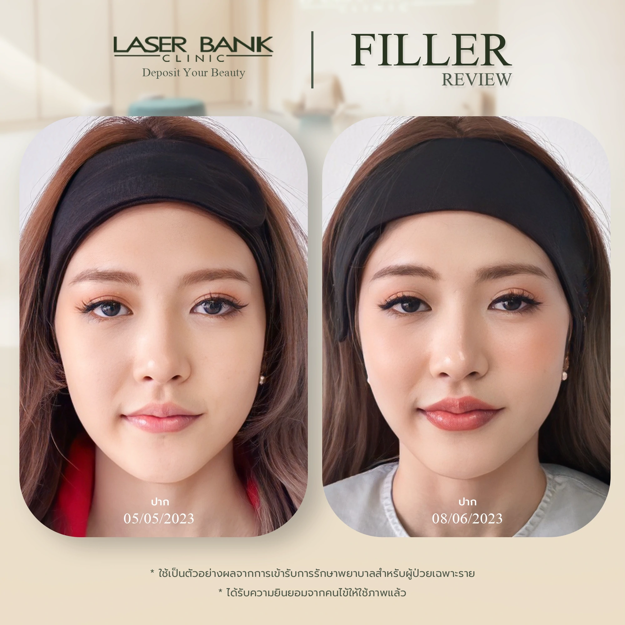 filler before after