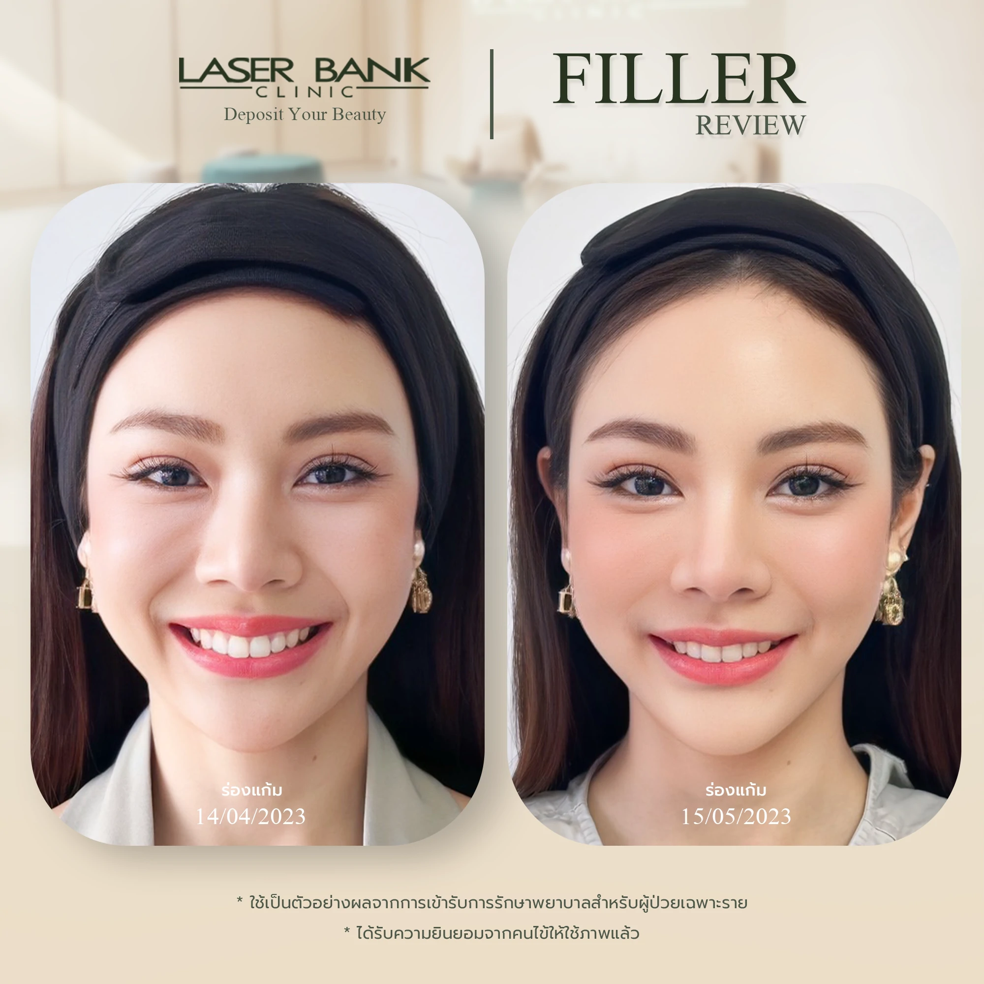 filler before after