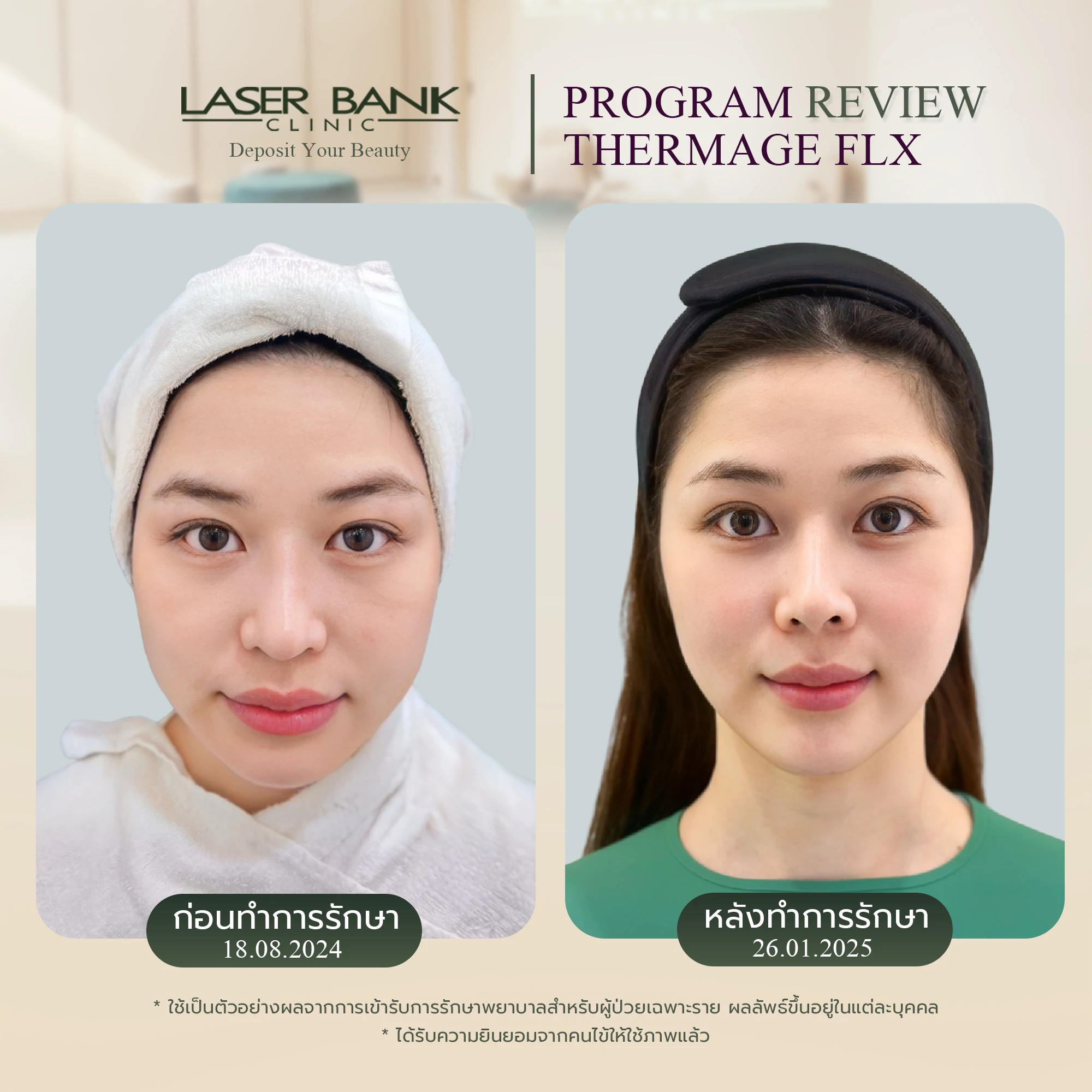 Thermage FLX 900 Short ผลลัพธ์