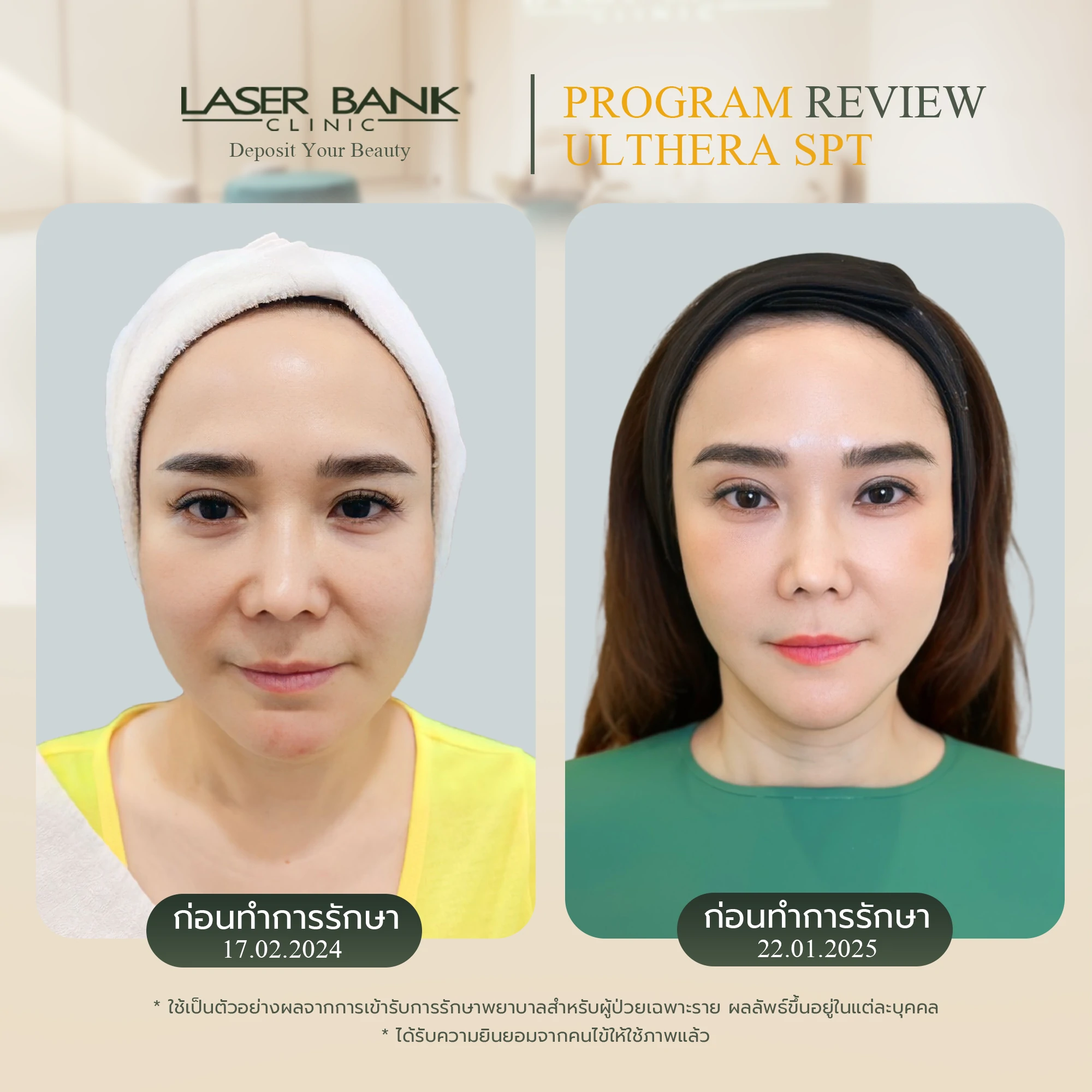 ผลลัพธ์ของUlthera