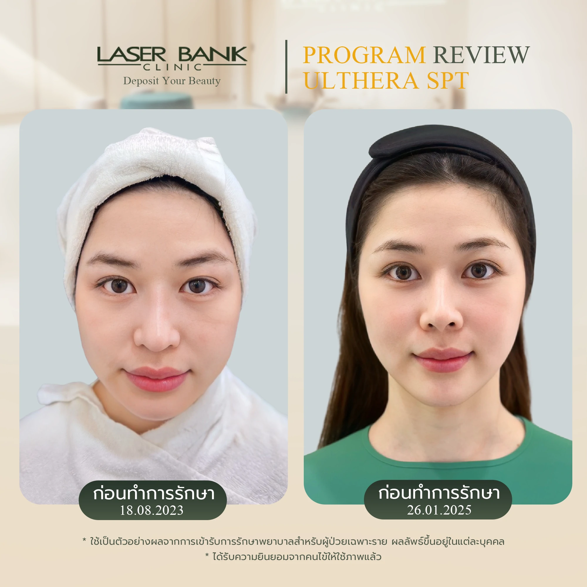 Before & After หลังจากทำUlthera