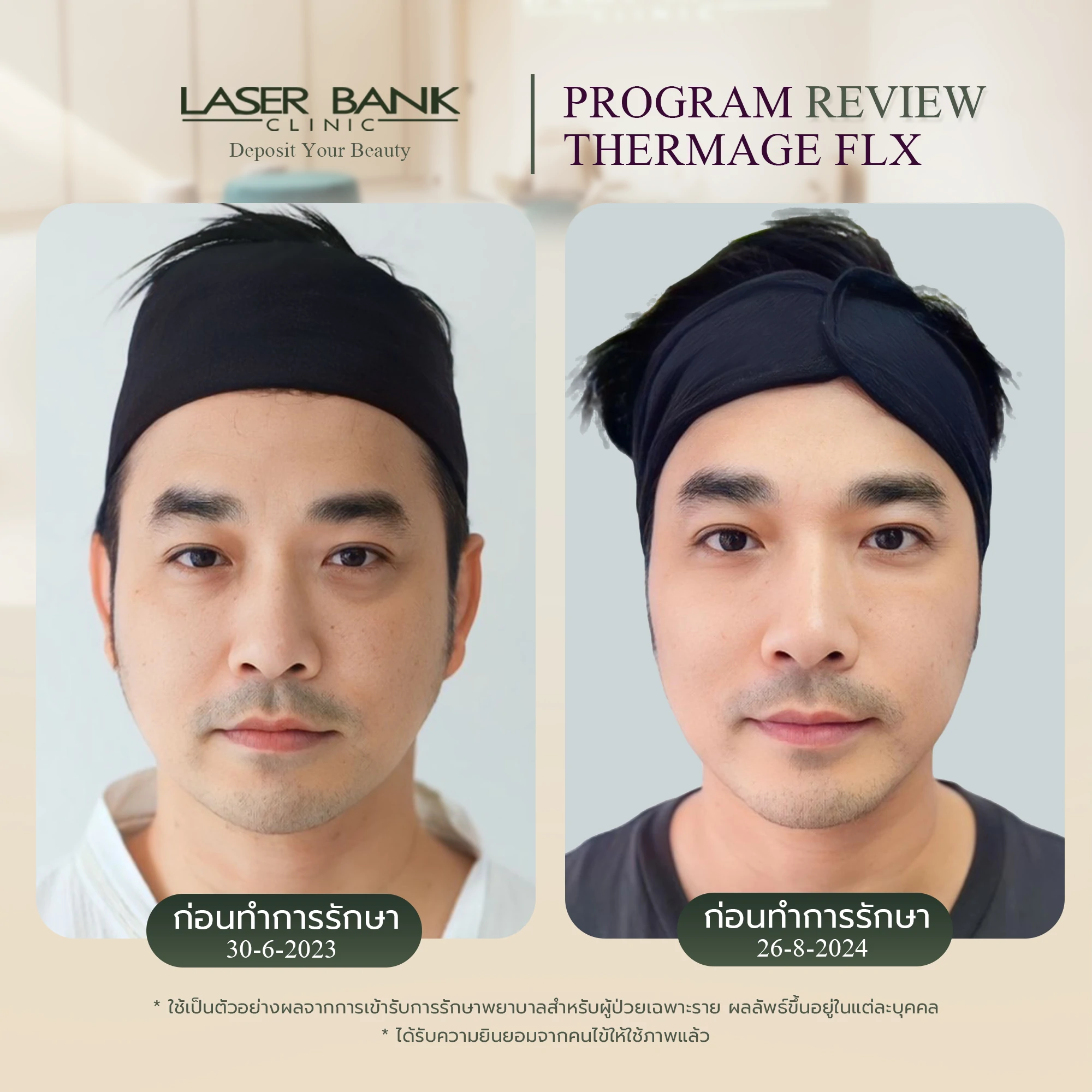 ขอบคุณ คุณเจมส์ เรืองศักดิ์ ที่มาใช้บริการ Thermage FLX