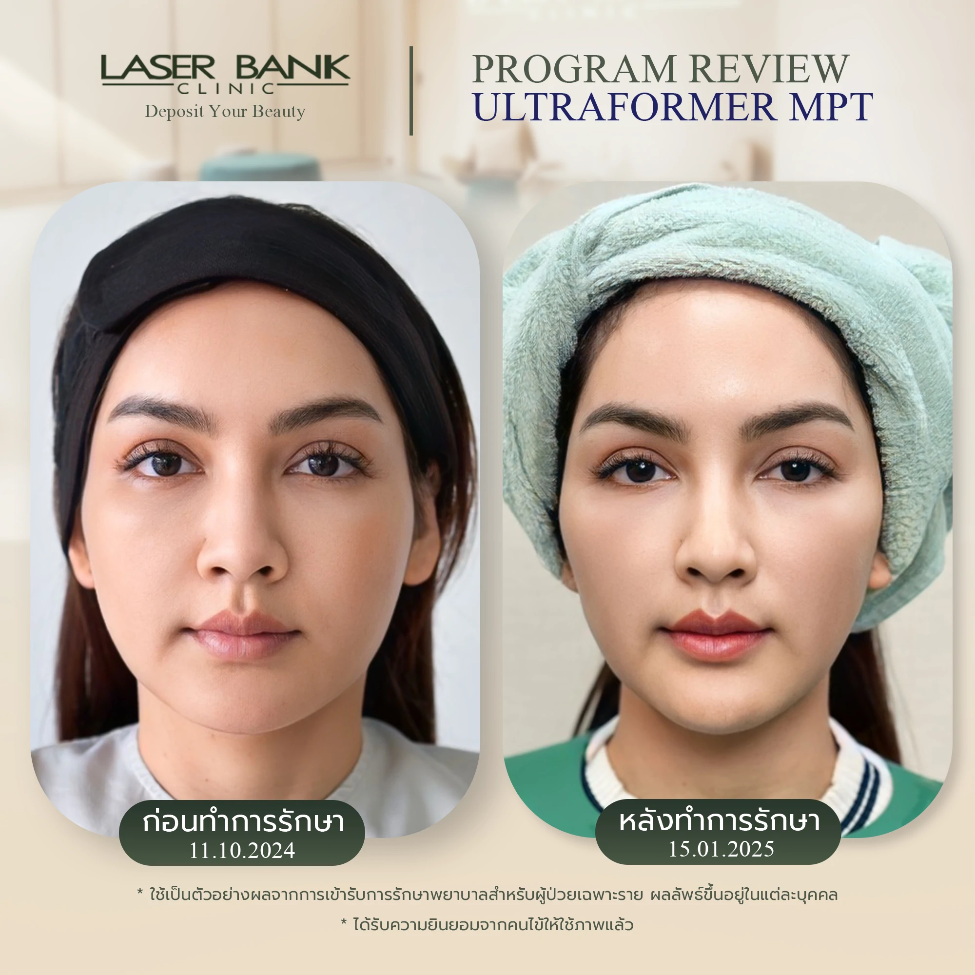 ขอบคุณ ครูก้อย ที่มาใช้บริการ Ultraformer MPT